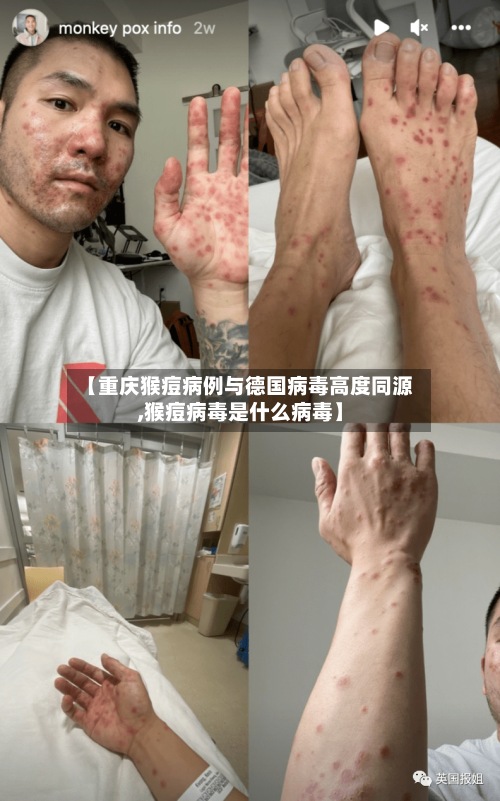 【重庆猴痘病例与德国病毒高度同源,猴痘病毒是什么病毒】