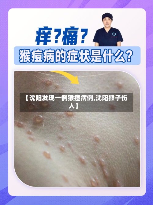 【沈阳发现一例猴痘病例,沈阳猴子伤人】